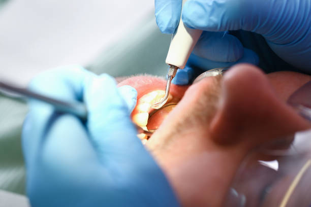 Best Emergency Wisdom Tooth Extraction in Brookfield, NJ