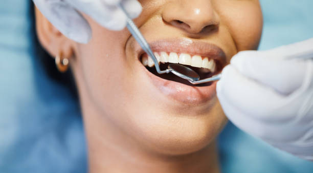Best Knocked-Out Tooth (Avulsed Tooth) Treatment in Brookfield, NJ